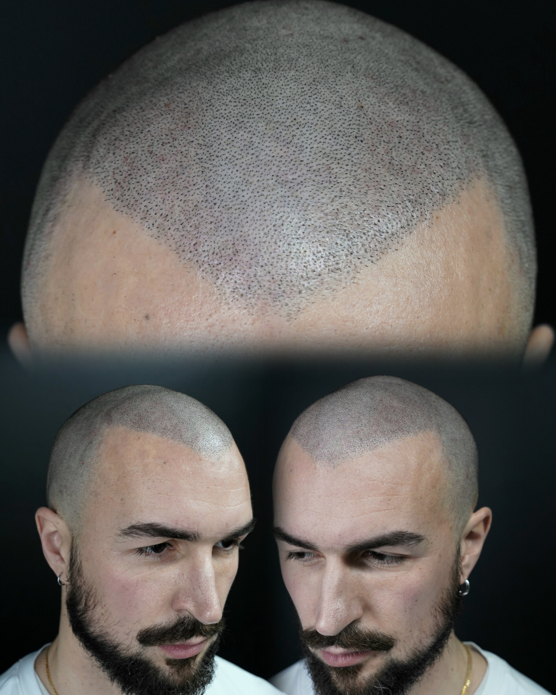 Tricopigmentation avant après By Guillaume Maizieres les metz