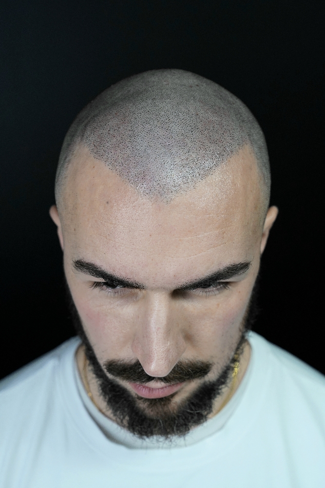 Tricopigmentation crâne après By Guillaume Maizieres les metz