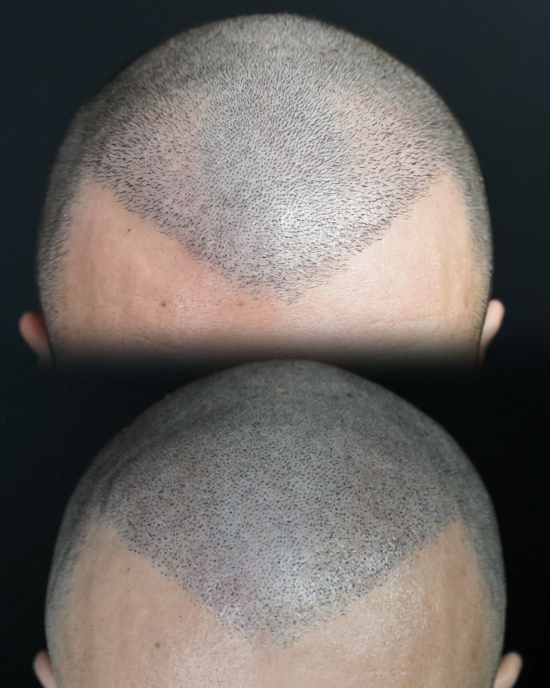 Tricopigmentation avant après crâne By Guillaume Maizieres les metz