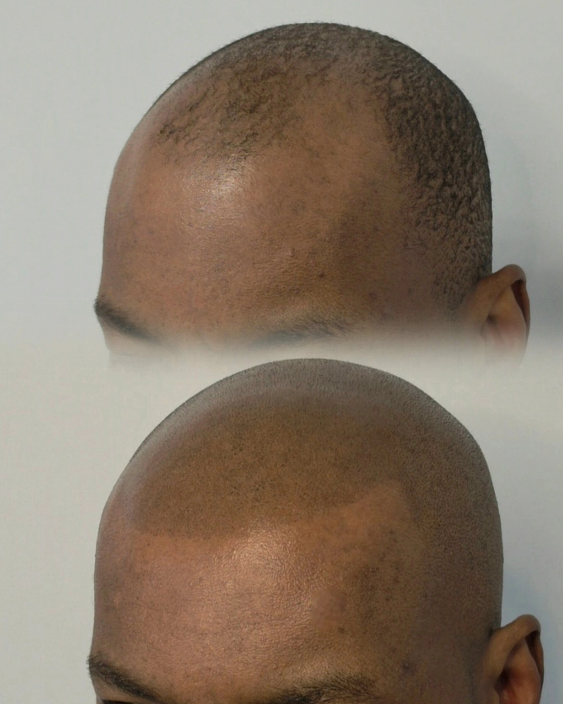 Tricopigmentation avant après By Guillaume Maizieres les metz