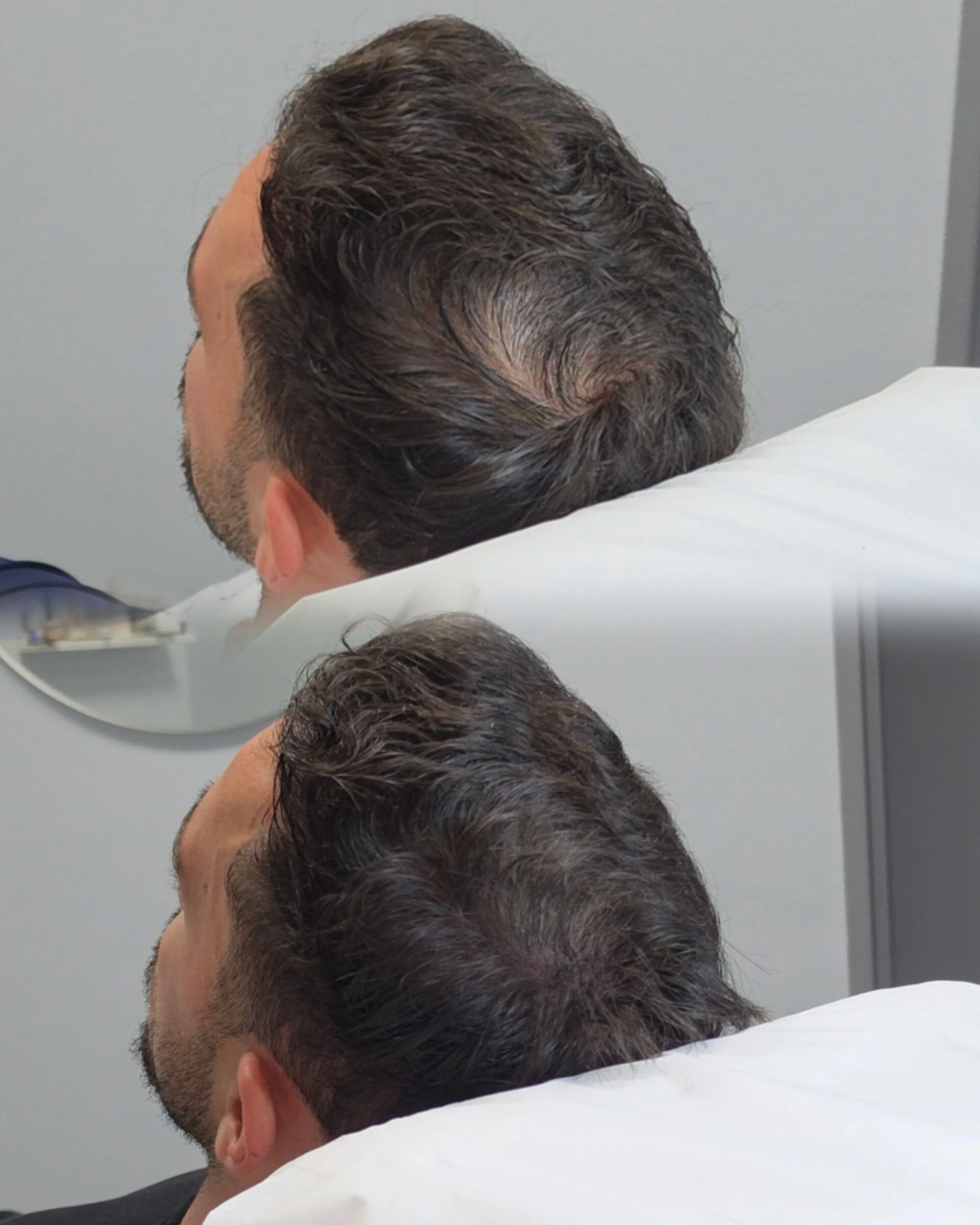 27507 Tricopigmentation avant après By Guillaume Maizieres les metz
